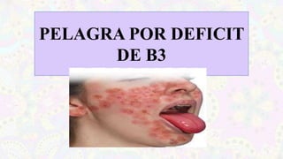 PELAGRA POR DEFICIT
DE B3
 