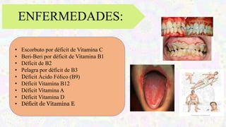 ENFERMEDADES:
• Escorbuto por déficit de Vitamina C
• Beri-Beri por déficit de Vitamina B1
• Déficit de B2
• Pelagra por déficit de B3
• Déficit Ácido Fólico (B9)
• Déficit Vitamina B12
• Déficit Vitamina A
• Déficit Vitamina D
• Déficit de Vitamina E
 