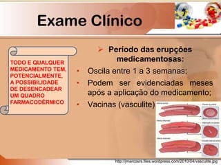Exame Clínico
 Período das erupções
medicamentosas:
• Oscila entre 1 a 3 semanas;
• Podem ser evidenciadas meses
após a aplicação do medicamento;
• Vacinas (vasculite).
http://jmarcosrs.files.wordpress.com/2010/04/vasculite.jpg
TODO E QUALQUER
MEDICAMENTO TEM,
POTENCIALMENTE,
A POSSIBILIDADE
DE DESENCADEAR
UM QUADRO
FARMACODÉRMICO
 