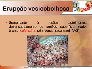 Erupção vesicobolhosa
• Semelhante à lesões autoimunes,
desencadeamento de pênfigo superficial (iodo,
bromo, cefalexina, primidona, itraconazol, AAS).
Eritema Multiforme. Fonte: http://dermatopet.com.br/eritema-multiforme
 