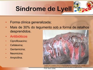 Síndrome de Lyell
• Forma clínica generalizada;
• Mais de 30% do tegumento sob a forma de retalhos
desprendidos.
• Antibióticos
• Ciprofloxacino;
• Cefalexina;
• Gentamicina;
• Neomicina;
• Ampicilina.
Cadela com suspeita clínica de farmacodermia a antibióticos do grupo β-
lactâmico, apresentando desprendimento da pele na região lombar.
Fonte: Aleixo (2008).
 