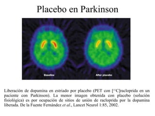 Placebo en Parkinson Liberación de dopamina en estriado por placebo (PET con  [ 11 C]racloprid a en un paciente con  Parkinson ). La menor imagen obtenida con placebo (solución fisiológica) es por ocupación de sitios de unión de racloprida por la dopamina liberada. De la Fuente Fernández  et al ., Lancet Neurol 1:85, 2002. 