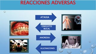 REACCIONES ADVERSAS
ATAXIA
ANOREXIA
ALUCINACIONES
GINGIVITIS
BUCAL
 