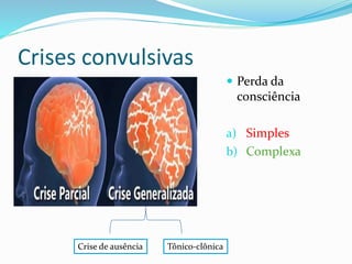Crises convulsivas
 Perda da
consciência
a) Simples
b) Complexa
Crise de ausência Tônico-clônica
 