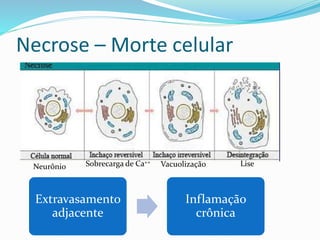 Necrose – Morte celular
Neurônio Vacuolização LiseSobrecarga de Ca++
Extravasamento
adjacente
Inflamação
crônica
 