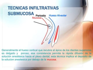 TECNICAS INFILTRATIVAS
     SUBMUCOSA Periostio Hueso Alveolar
                          Mucosa




Generalmente el hueso cortical que recubre el ápice de los dientes superiores
es delgado y poroso, esa consistencia permite la rápida difusión de la
solución anestésica hacia el plexo dental, esta técnica implica el deposito de
la solucion anestesica por debajo de la mucosa.
 