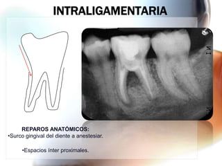 INTRALIGAMENTARIA




     REPAROS ANATÓMICOS:
•Surco gingival del diente a anestesiar.

     •Espacios ínter proximales.
 