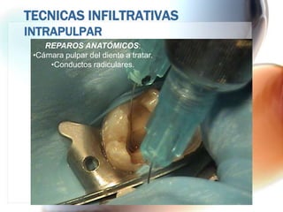 TECNICAS INFILTRATIVAS
INTRAPULPAR
    REPAROS ANATÓMICOS:
 •Cámara pulpar del diente a tratar.
     •Conductos radiculares.
 