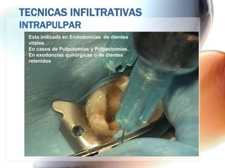 TECNICAS INFILTRATIVAS
INTRAPULPAR
 Esta indicada en Endodoncias de dientes
 vitales
 En casos de Pulpotomías y Pulpectomías.
 En exodoncias quirúrgicas o de dientes
 retenidos
 