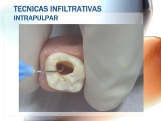 TECNICAS INFILTRATIVAS
INTRAPULPAR
 