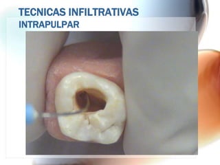 TECNICAS INFILTRATIVAS
INTRAPULPAR
 