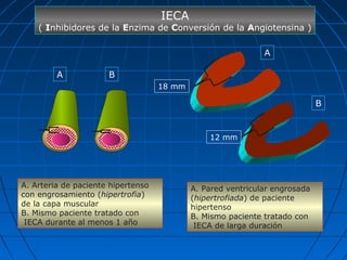 A. Arteria de paciente hipertenso
con engrosamiento (hipertrofia)
de la capa muscular
B. Mismo paciente tratado con
IECA durante al menos 1 año
A B
B
A
A. Pared ventricular engrosada
(hipertrofiada) de paciente
hipertenso
B. Mismo paciente tratado con
IECA de larga duración
IECA
( Inhibidores de la Enzima de Conversión de la Angiotensina )
18 mm
12 mm
 