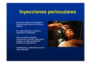 Inyecciones perioculares
ƒ Alcanzan detrás del diafragma
iridiano mejor que los fármacos
tópicos
ƒ Ej: subconjuntival, subtenon,
peribulbar, retrobulbar
ƒ Esta vía evite el epitelio
conjuntival y corneal. Ideal para
drogas con baja solubilidad
lipídica (el. penicilinas)
ƒ Anestésicos y esteroides son los
más utilizados
 