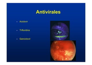 Antivirales
ƒ Aciclovir
ƒ Trifluridina
ƒ Ganciclovir
 