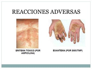 REACCIONES ADVERSAS
 
