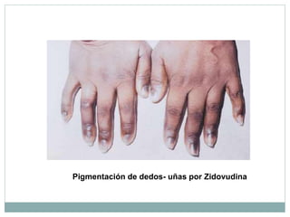Pigmentación de dedos- uñas por Zidovudina
 