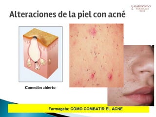 Farmagela: CÓMO COMBATIR EL ACNE
Comedón abierto
Alteraciones de la piel con acné
 