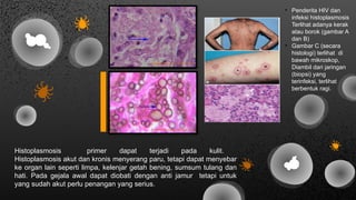 Infeksi Ragi Comprehensive Overview of Systemic Fungal Infections and Mycoses ...