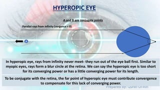 Prepared by: Qurat-Ul-Ain
A
A and B are conjugate points
Parallel rays from infinity (vergence = 0)
In hyperopic eye, rays from infinity never meet- they run out of the eye ball first. Similar to
myopic eyes, rays form a blur circle at the retina. We can say the hyperopic eye is too short
for its converging power or has a little converging power for its length.
To be conjugate with the retina, the far point of hyperopic eye must contribute convergence
to compensate for this lack of converging power.
HYPEROPIC EYE
 