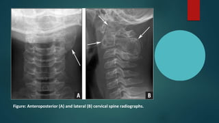 Figure: Anteroposterior (A) and lateral (B) cervical spine radiographs.
 