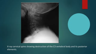 X-ray cervical spine showing destruction of the C3 vertebral body and its posterior
elements.
 