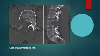 CTof aneurysmalbone cyst.
 