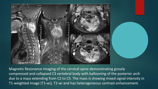 Magnetic Resonance Imaging of the cervical spine demonstrating grossly
compressed and collapsed C3 vertebral body with ballooning of the posterior arch
due to a mass extending from C2 to C5. The mass is showing mixed signal intensity in
T1-weighted image (T1-wi), T2-wi and has heterogeneous contrast enhancement.
 