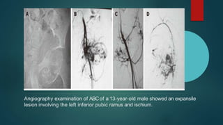 Angiography examination of ABCof a 13-year-old male showed an expansile
lesion involving the left inferior pubic ramus and ischium.
 