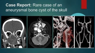 Case Report: Rare case of an
aneurysmal bone cyst of the skull
 