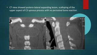 • CT view showed postero-lateral expanding lesion, scalloping of the
upper aspect of C3 spinous process with no periosteal bone reaction.
 