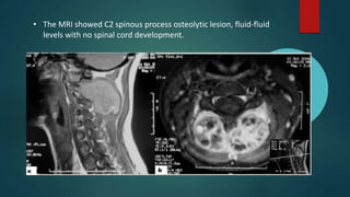 • The MRI showed C2 spinous process osteolytic lesion, fluid-fluid
levels with no spinal cord development.
 