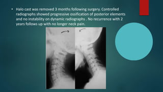 • Halo cast was removed 3 months following surgery. Controlled
radiographs showed progressive ossification of posterior elements
and no instability on dynamic radiographs . No recurrence with 2
years follows up with no longer neck pain.
 
