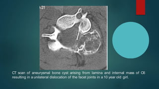 CT scan of aneurysmal bone cyst arising from lamina and internal mass of C6
resulting in a unilateral dislocation of the f...