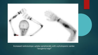 Increased radioisotope uptake peripherally with a photopenic center.
"doughnut sign"
 