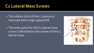  The inferior third of the C1 lamina is
removed with a high-speed drill.
 The entry point for the C1 lateral mass
screw is identified at the center of the C1
lateral mass.
23
 