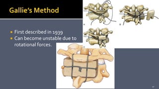  First described in 1939
 Can become unstable due to
rotational forces.
42
 