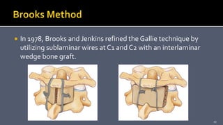  In 1978, Brooks and Jenkins refined the Gallie technique by
utilizing sublaminar wires at C1 and C2 with an interlaminar
wedge bone graft.
43
 