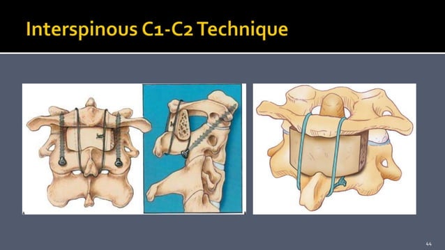 Cervical Fusion: C1-C2 Fusion