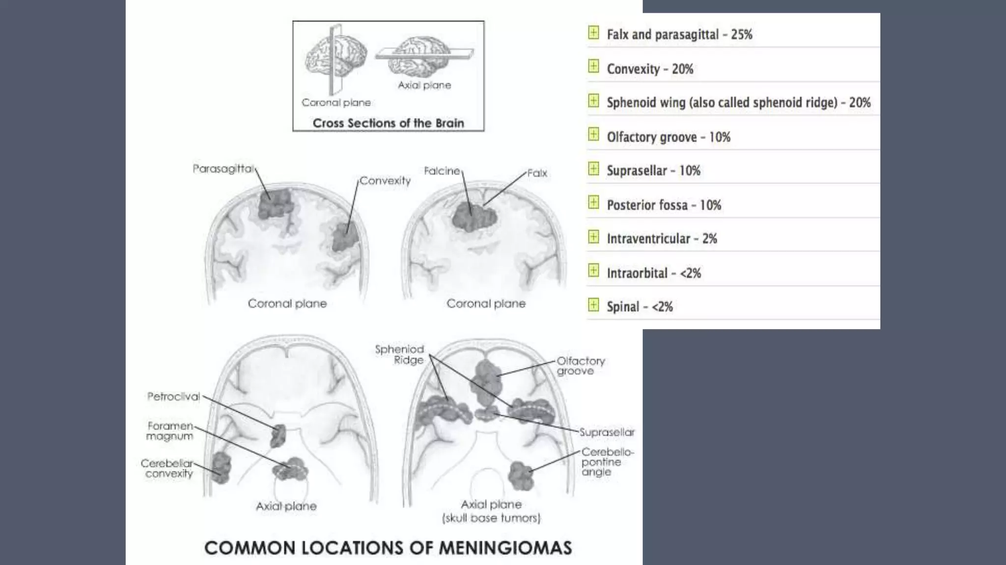 Parasagittal Meningioma PPTX Parasagittal Meningioma PPTX