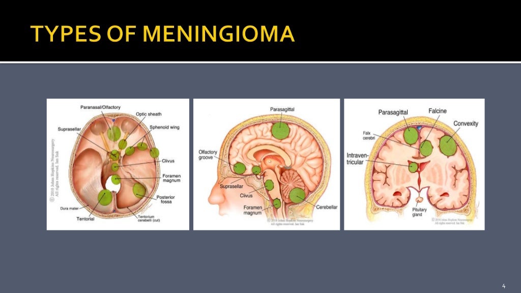 Parasagittal Meningioma Parasagittal Meningioma