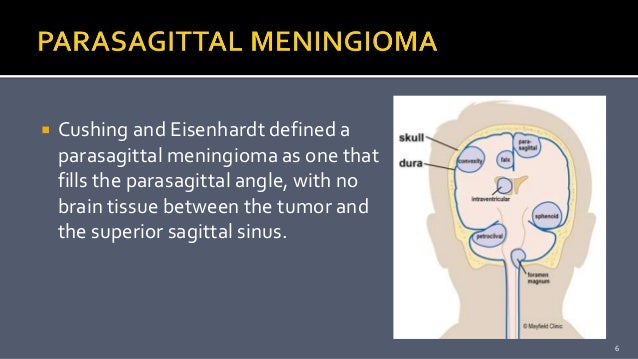 Parasagittal Meningioma Parasagittal Meningioma