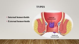 TYPES
• Internal hemorrhoids
• External hemorrhoids
 