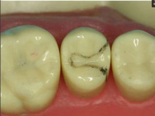 Proximal bevel on facial and lingual walls of the box With garnet disk OR THIN flame shape
bur and blend with Gingival and...