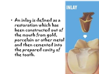 • An inlay is defined as a
restoration which has
been constructed out of
the mouth from gold,
porcelain or other metal
and...