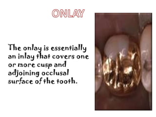 The onlay is essentially
an inlay that covers one
or more cusp and
adjoining occlusal
surface of the tooth.

 