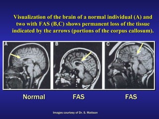 Visualization of the brain of a normal individual (A) and two with FAS (B,C) shows permanent loss of the tissue indicated by the arrows (portions of the corpus callosum). Images courtesy of Dr. S. Mattson Normal FAS FAS 