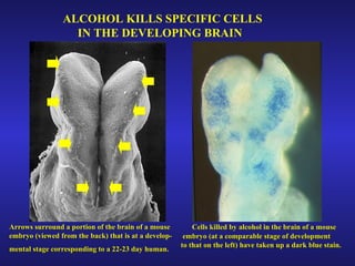ALCOHOL KILLS SPECIFIC CELLS  IN THE DEVELOPING BRAIN Arrows surround a portion of the brain of a mouse  embryo (viewed from the back) that is at a develop- mental stage corresponding to a 22-23 day human.   Cells killed by alcohol in the brain of a mouse  embryo (at a comparable stage of development  to that on the left) have taken up a dark blue stain. 