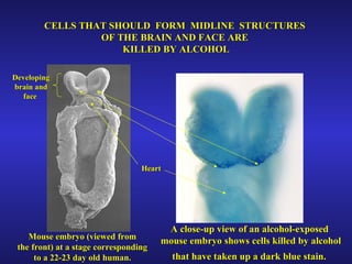 CELLS THAT SHOULD  FORM  MIDLINE  STRUCTURES  OF THE BRAIN AND FACE ARE  KILLED BY ALCOHOL Developing brain and face  Heart Mouse embryo (viewed from the front) at a stage corresponding  to a 22-23 day old human. A close-up view of an alcohol-exposed  mouse embryo shows cells killed by alcohol that have taken up a dark blue stain.   
