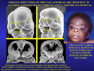 EYE EYE A C B D MOUTH MOUTH NOSTRILS NOSTRILS MIDLINE STRUCTURES OF THE FACE AND BRAIN ARE  DEFICIENT  IN ALCOHOL-EXPOSED MOUSE EMBRYOS AND IN  INDIVIDUALS WITH FAS THE FACE OF A CHILD WITH FULL-BLOWN FAS HAS FEATURES THAT CAN BE CAUSED BY  DAMAGE TO MIDLINE STUCTURES. COMPARISON OF THE FACE (A) AND INTERIOR OF THE BRAIN (B) OF A NORMAL  MOUSE EMBRYO AND ONE DAMAGED BY ALCOHOL (C&D) SHOWS THAT THE NOSTRILS  ARE ABNORMALY POSITIONED (C) AND THE BRAIN IS MISSING MIDLINE STRUCTURES (D).   