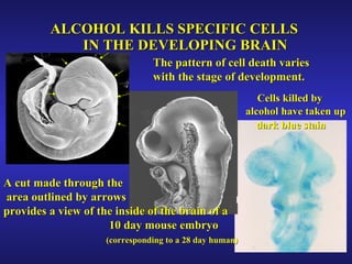 ALCOHOL KILLS SPECIFIC CELLS    IN THE DEVELOPING BRAIN A cut made through the area outlined by arrows provides a view of the inside of the brain of a  10 day mouse embryo  (corresponding to a 28 day human) Cells killed by  alcohol   have taken up  dark blue stain   The pattern of cell death varies  with the stage of development. 